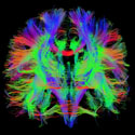 tractography fibers